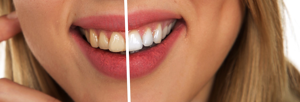 Teeth Whitening Dentist In Rancho Cucamonga