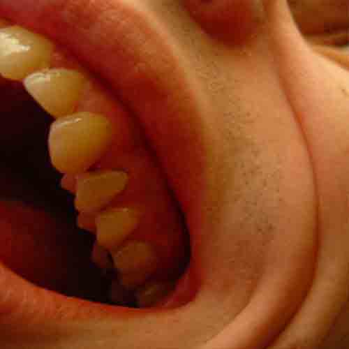 Gum Disease