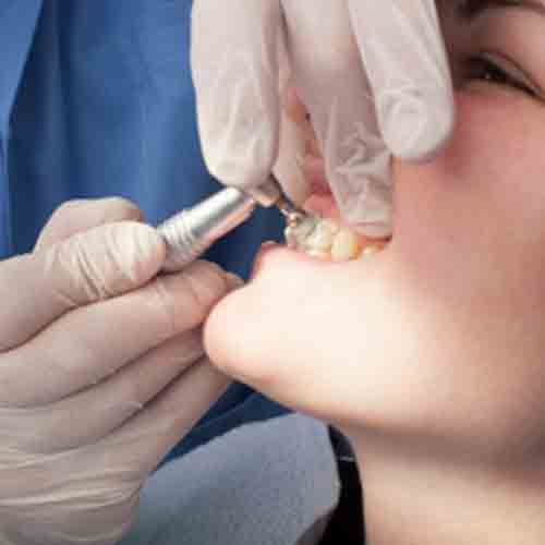Teeth Whitening