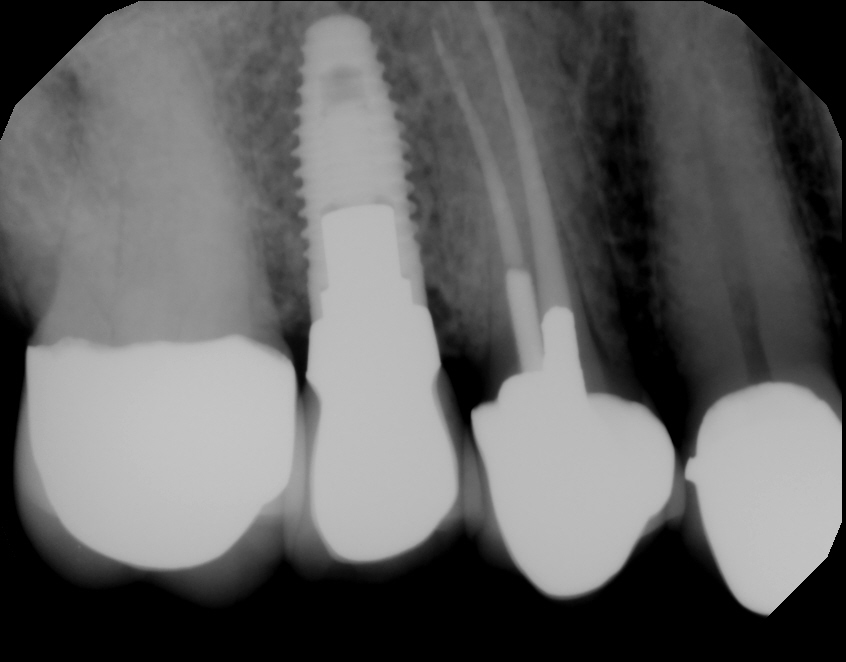 What Are Conventional Dental Implant Options?