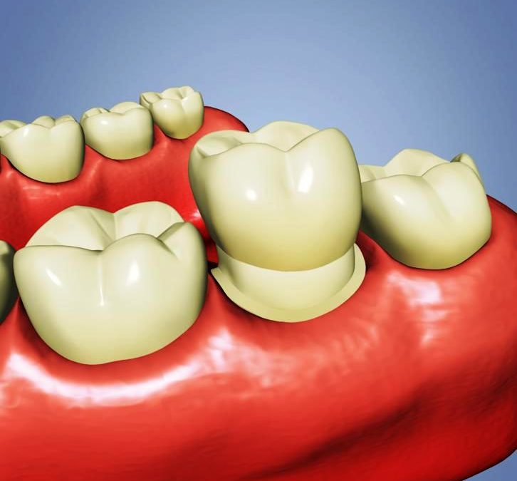Dental Crowns Best Local Rancho Cucamonga Dentist