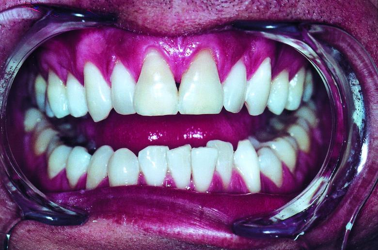 Visit Your Dentist Immediately Once You Get A Cavity