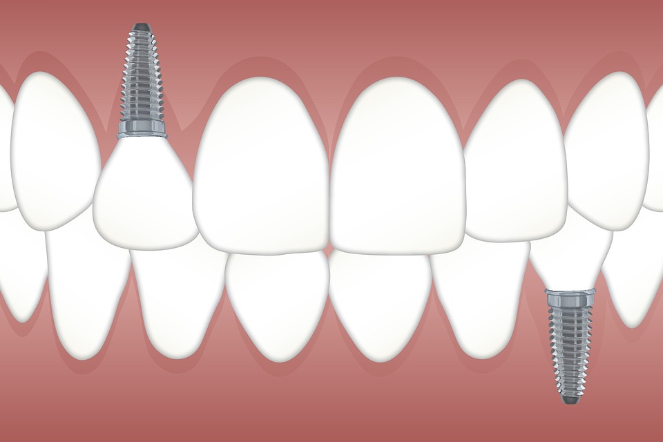 What To Do After Surgery – Rancho Cucamonga Dentist