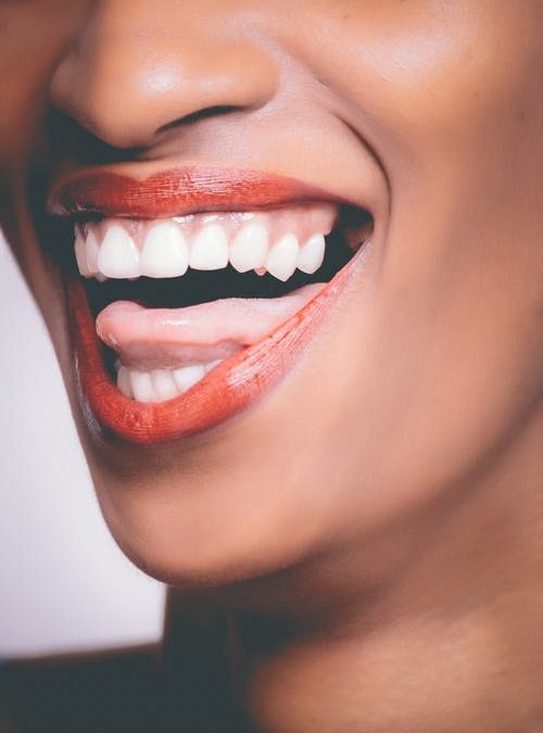 After Whitening Treatment – Rancho Cucamonga Dentist