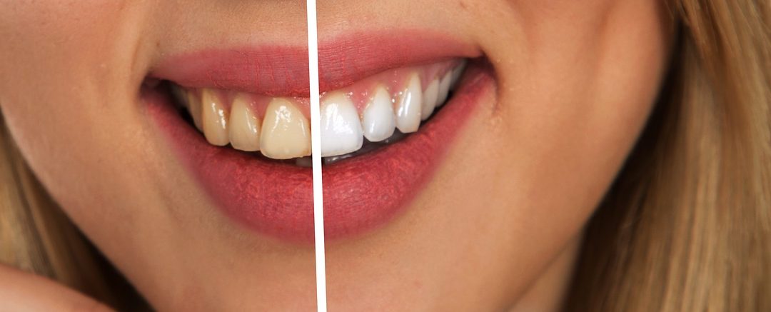 Great Tips On Whitening Of Veneers