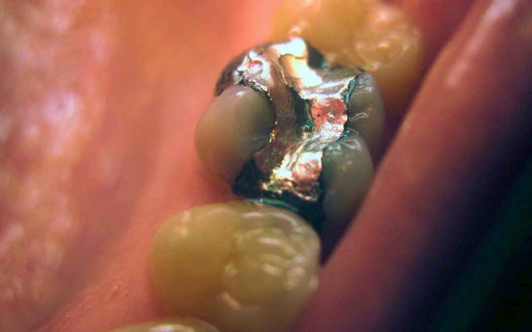 Getting A Better Idea Of How Tooth Fillings Work