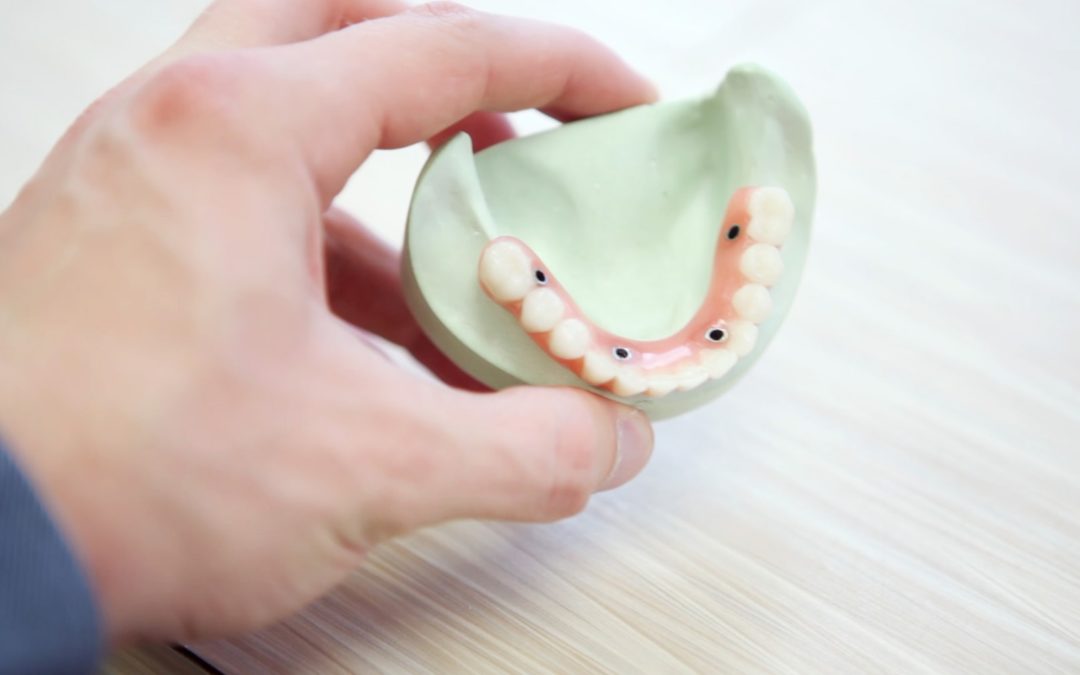 Tooth Decay Rancho Cucamonga Dentist