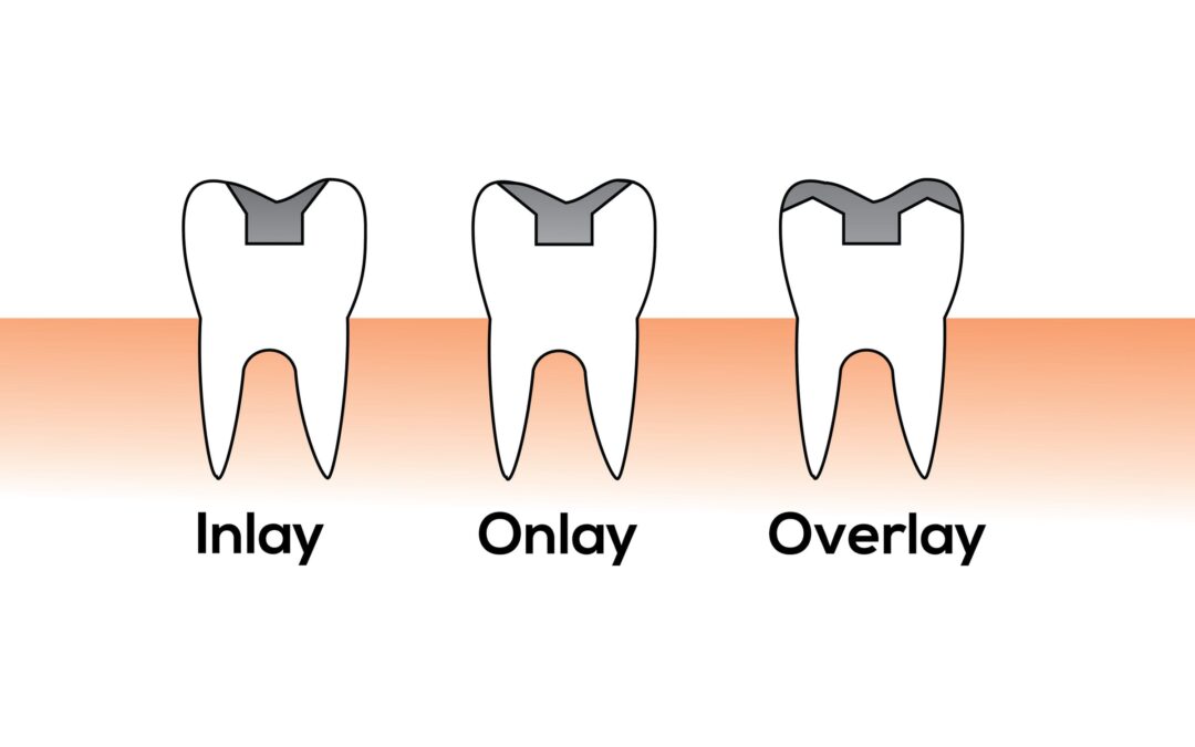 Getting A Better Picture When It Comes To Dental Crowns