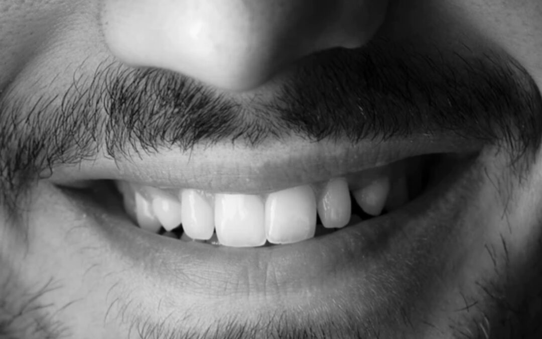 Essential Tips On Whitening Veneers