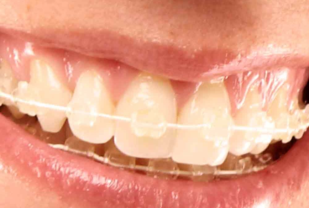 Essential Benefits Of Clear Braces For Adults